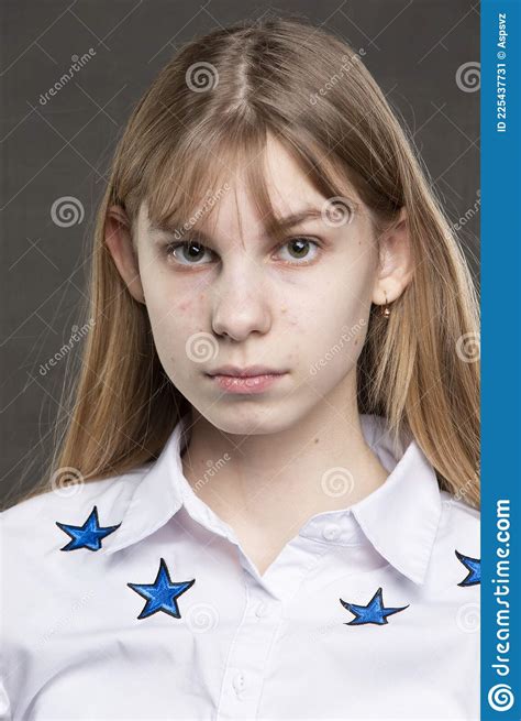 La Cara De Una Adolescente Con Granos Imagen De Archivo Imagen De Bacteria Atractivo 225437731