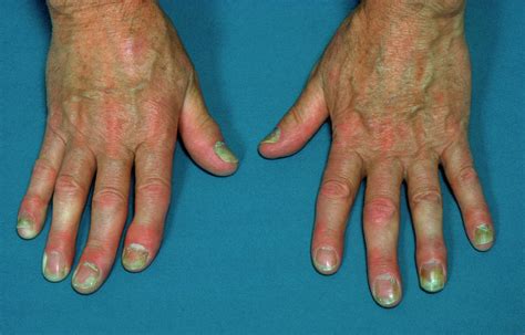 Psoriasis Affecting The Fingers Photograph By James Stevensonscience