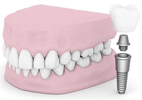Affordable Dental Implants In Ipswich Dentist Ipswich