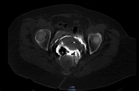 Axial Ct Image Of The Pelvis Shows The Presence Of Barium Contrast