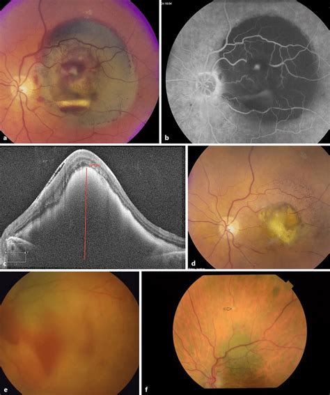 A Case 3 Color Fundus Photos Of The Left Eye At Baseline Showing A