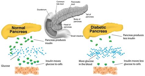 How To Heal Your Pancreas Diabetes Diabeteswalls