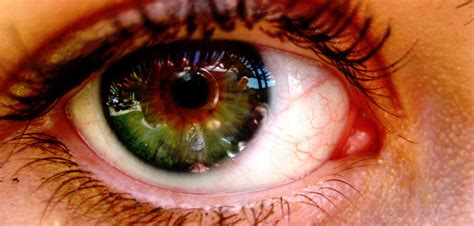 Epilepsy Drug May Preserve Eyesight For People With Ms