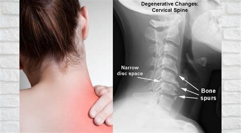 Neck Pain Cervical Spondylosis What Is Spondylosis And Do You Treat It
