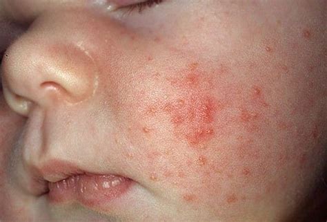 Dermatite Atopica Sintomi Rimedi E Cura Nanopress
