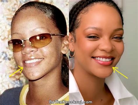 Rihanna Plastic Surgery Comparison Photos
