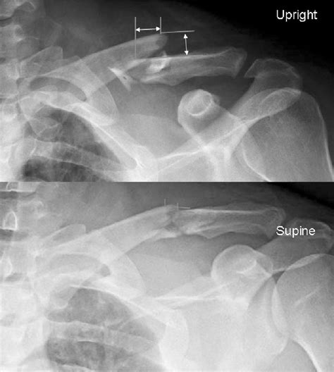 Clavicle Fracture