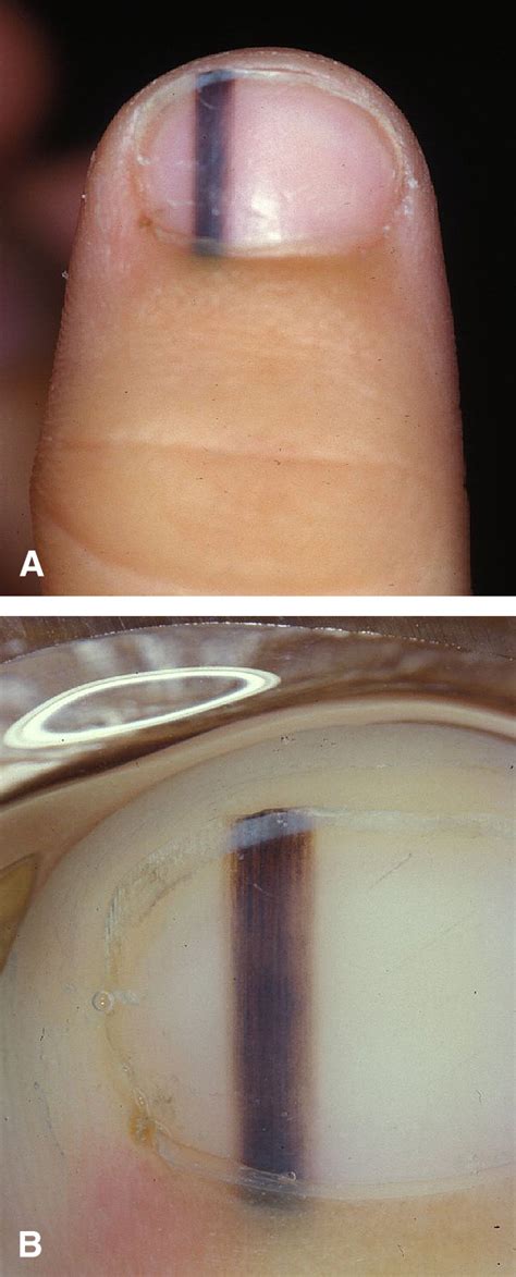 Diagnosis And Management Of Nail Pigmentations Journal Of The