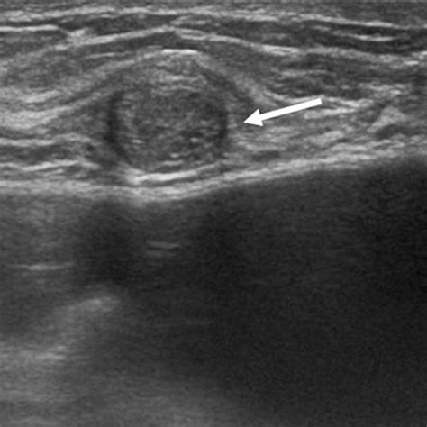 A 63 Year Old Woman Invasive Ductal Carcinoma Breast Ultrasound Shows
