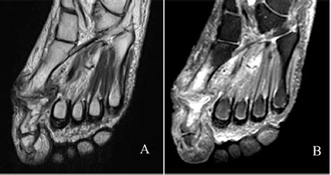 Figure 5 From The Evaluation Of Mri In Diagnosis Of Osteomyelitis In