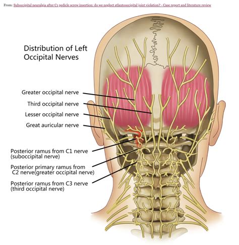 Spinal Surgery Vs Migraine Surgery Dr Adam Lowenstein