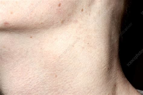 Enlarged Lymph Nodes Stock Image C0284520 Science Photo Library