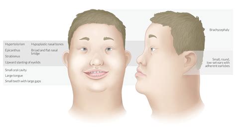 An epicanthic fold, epicanthal fold, or epicanthus is a skin fold of the upper. Flat Nasal Bridge And Epicanthal Folds - Down Syndrome ...