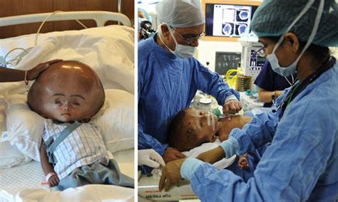 Parents Of Baby Roona Begum Whose Head Swelled To 3 Times Normal Size