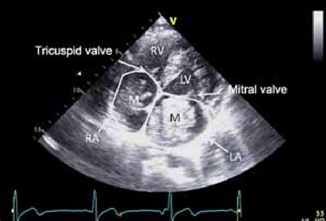 Cardiac Ultrasound Apical 4 Chamber View Shows A Mass In The Right As