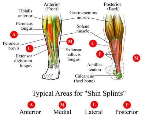 What Are The Most Common Running Injuries Mispibo Shin Splints