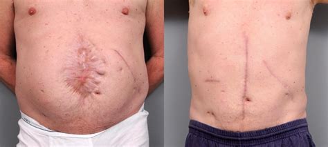 Appendix Scar Removal Before And After