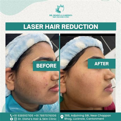 Skin Specialist In Lucknow Dr Dishas Hair And Skin Clinic Skin