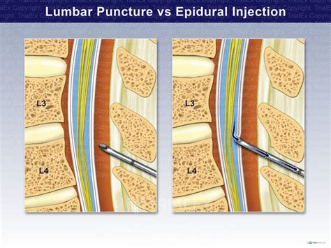 Lumbar Puncture Vs Epidural Injection Trial Exhibits Inc