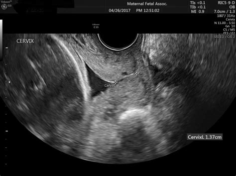 Transvaginal Ultrasound Maternal Fetal Associates Of The Mid Atlantic