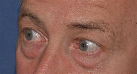 Fat Transposition Lower Eyelid Surgery For Tear Trough Deformity Eyelid Surgery Before And