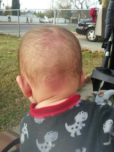 Red Spots On Back Of Babys Head Glow Community