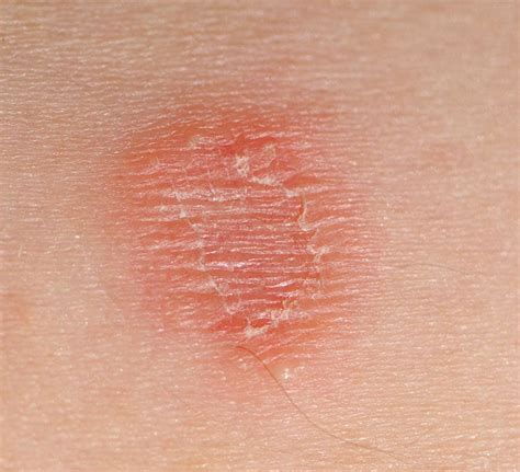 Skin Lesions Pictures Causes Types Risks Diagnosis And Treatments