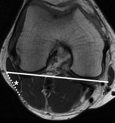 Mri Of The Distal Biceps Femoris Muscle Normal Anatomy Variants And