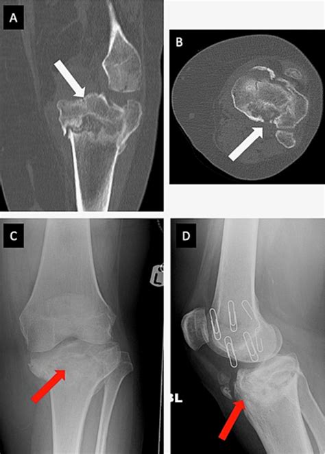 A And B Ct Imaging Of The Left Knee Joint Demonstrating Fracture Union