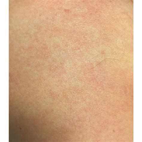 Maculopapular Rash Noted On Admission On The Patients Chest