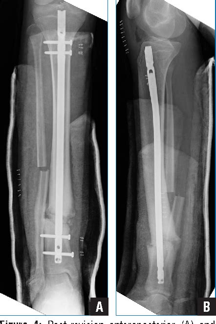 Figure 4 From Outcomes Using Titanium Elastic Nails For Open And Closed
