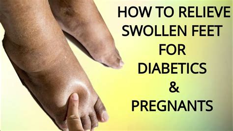 Simple Home Remedies To Relieve Swollen Feet For Diabetics And