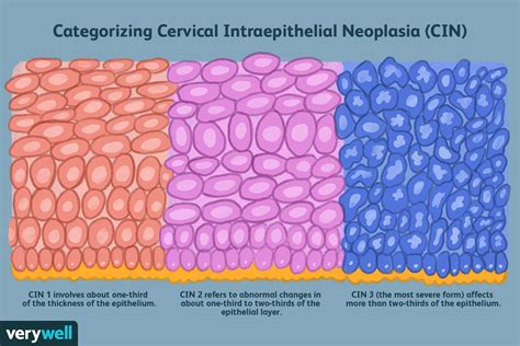 Oznaki i objawy śródnabłonkowej neoplazji szyjki macicy Medycyna