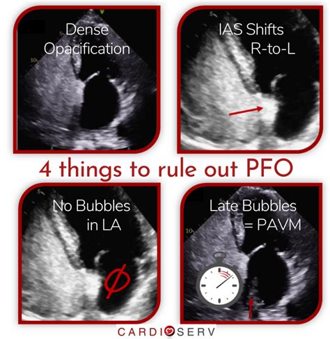 Echo Bubble Studies Are The Recommended Test To Rule Out A Pfo Learn