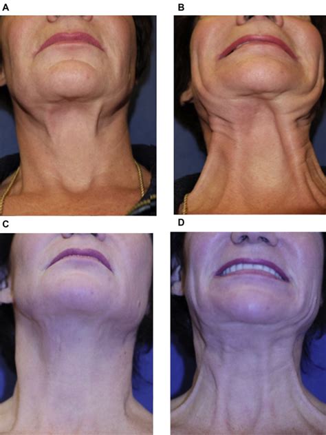 Neck Deformities In Plastic Surgery Facial Plastic Surgery Clinics