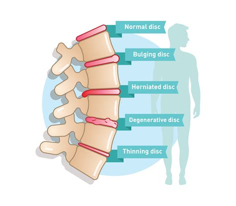 degenerative disc disease osteoarthritis causes sympt