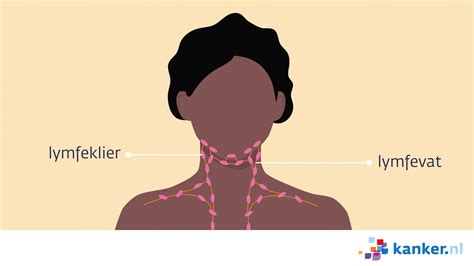 Verwijdering Van De Halsklieren Bij Keelkanker Halsklierdissectie