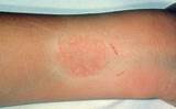 Contact Eczema Treatment Pictures