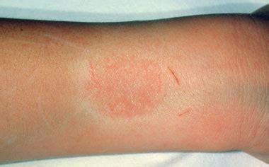 Itching is a common symptom. NHS 111 Wales - Encyclopaedia : Contact dermatitis