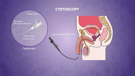 Cystoscopy Youtube