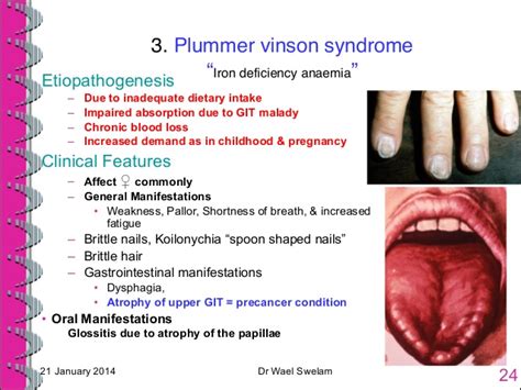 The syndrome is extremely rare. yildontanju - Plummer-Vinson sendromu