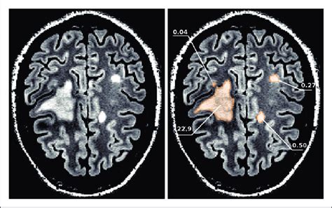 A Slice Through Flair Mri Image Of A Patient With Multiple Sclerosis