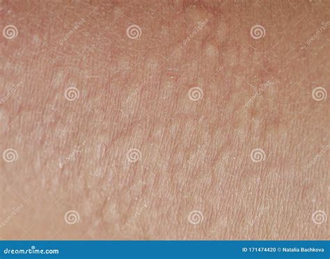 Unhealthy Irritated Human Skin Texture Covered With Allergic Bumps And