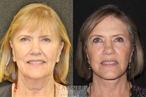 Facelift Neck Lift Before And After Photo Gallery Denver Co Ladner Facial Plastic Surgery