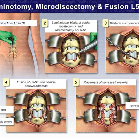 Laminotomy Microdiscectomy And Fusion L5 S1 Trial Exhibits In