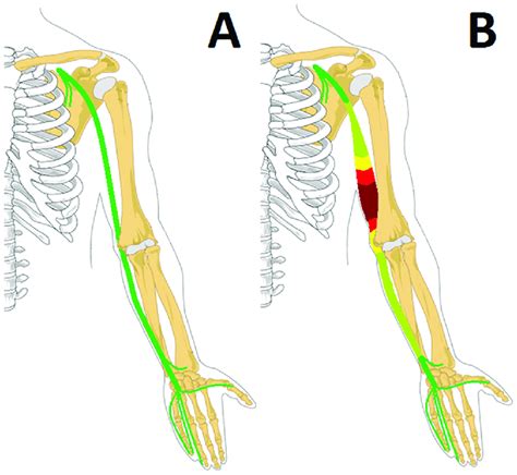 Pattern Of Nerve Enlargement In Leprosy A Normal Ulnar Nerve