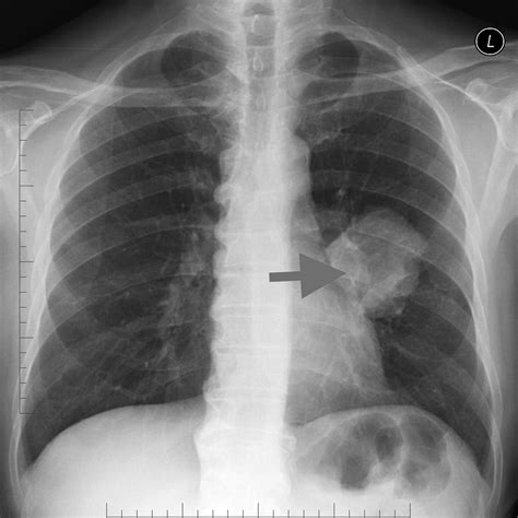 collection 92 pictures lung cancer x rays photos excellent