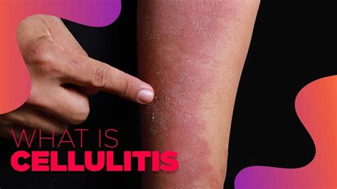 What Is Cellulitis Symptoms And Treatment Options Youtube