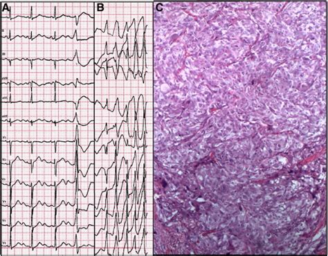 An Unusual Etiology For Acquired Long Qt Syndrome And Torsade De