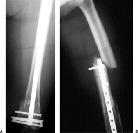 Femoral Shaft Fractures Retrograde Nailing Musculoskeletal Key
